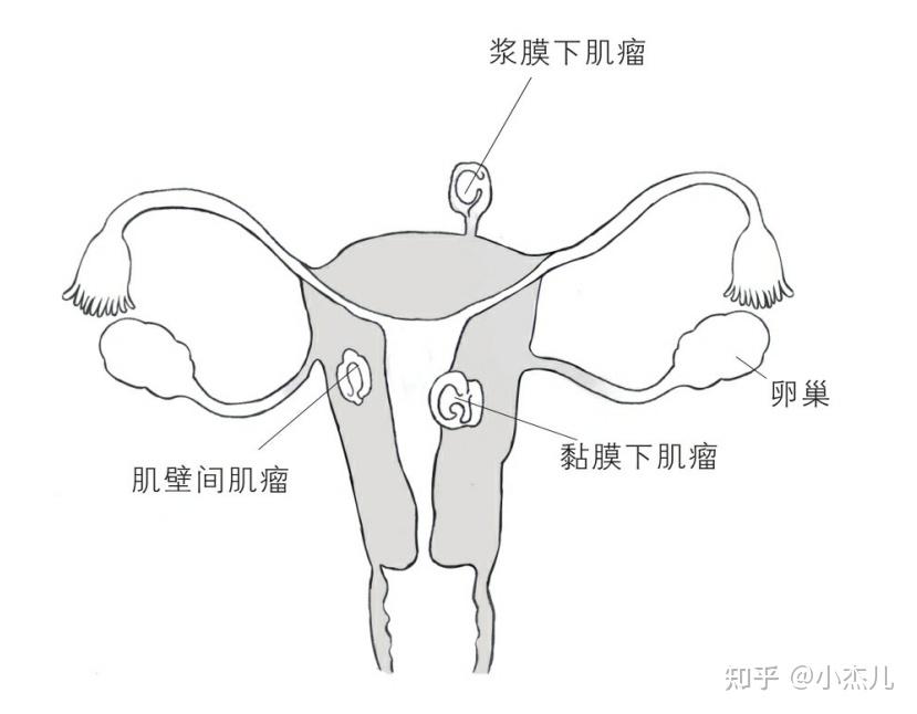 子宫肌瘤是如何形成的