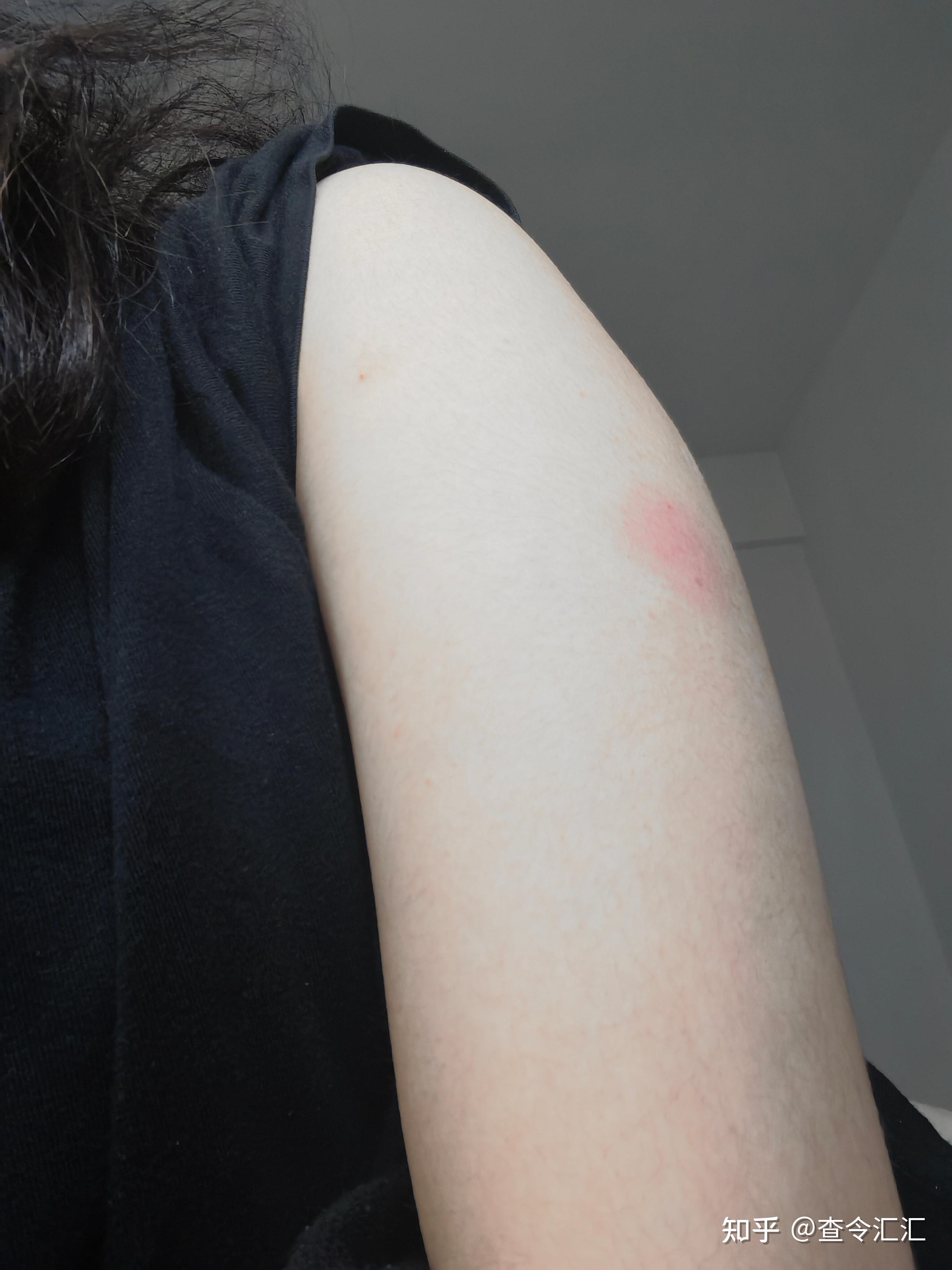 有朋友们接种完新冠疫苗胳膊肿了的嘛