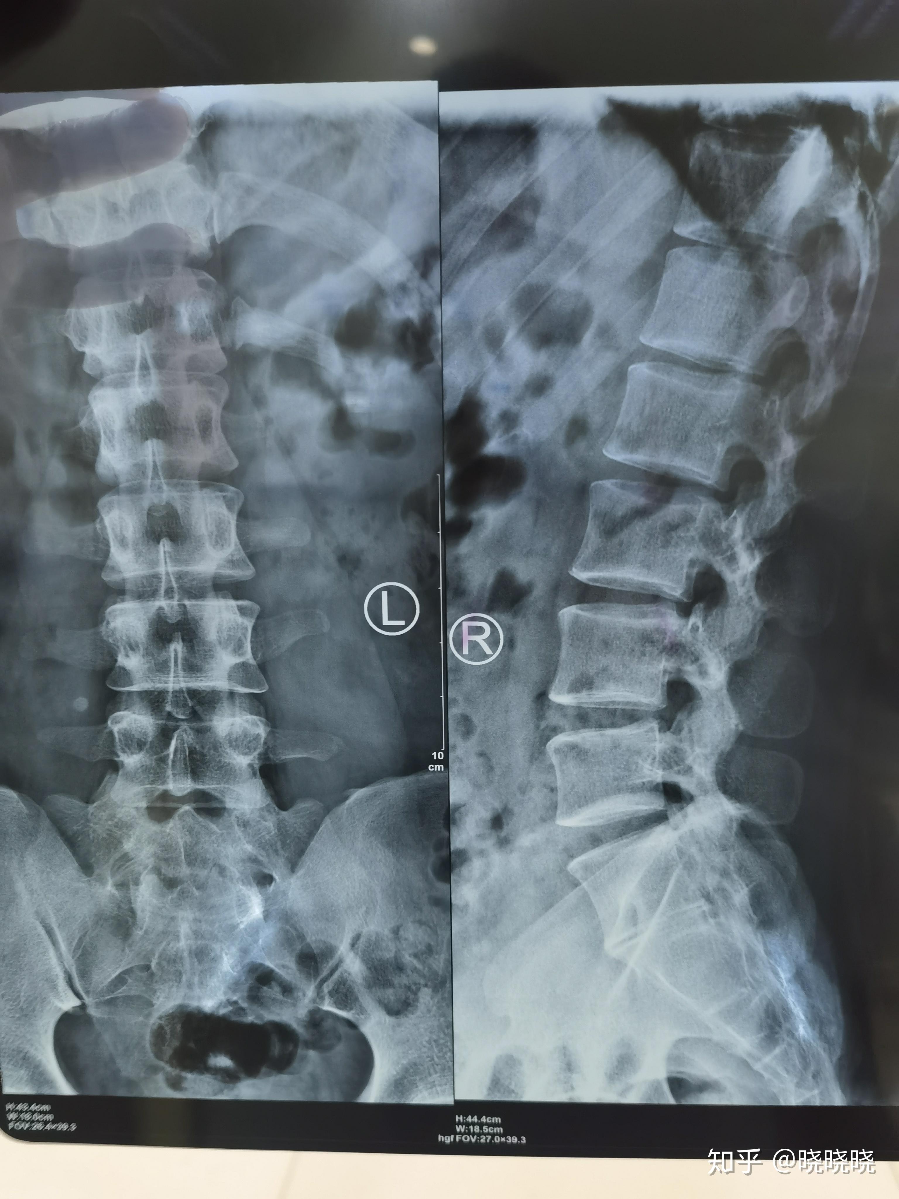 腰5椎体骶化 - 知乎