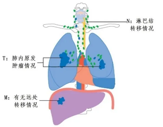 肺癌是如何进行分期分型突变分类的?