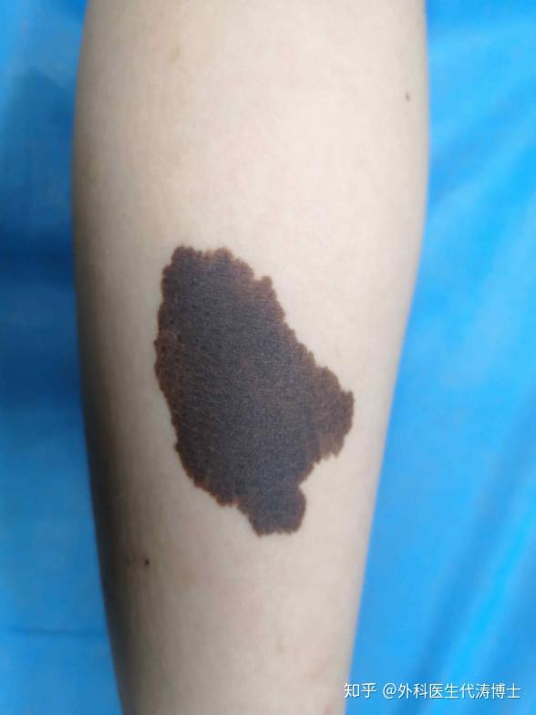 先天性巨痣是黑色素细胞痣的一种,为较少见的一种先天性皮肤良性肿瘤