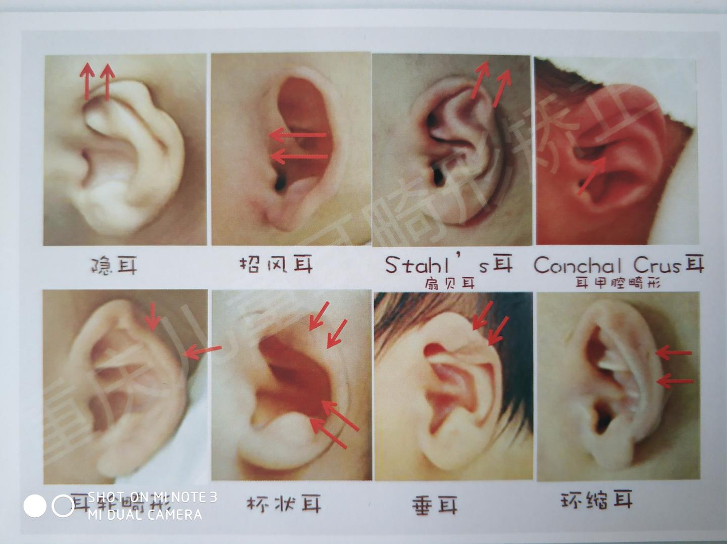 警惕新生儿耳廓畸形越早就医越好