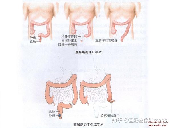 低位直肠癌哪些建议永久造瘘?哪些人可做冷冻消融保肛