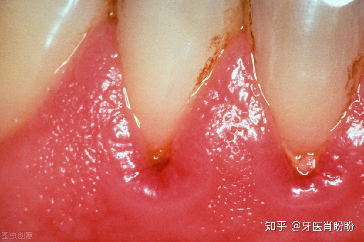 比蛀牙还可怕的牙龈萎缩你知道多少