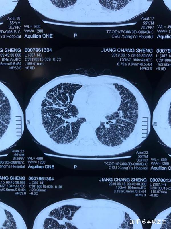 感染肺结核后多久拍ct能发现?还有什么判断途经?听医生解答