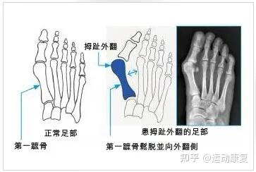 拇外翻经常脚疼的人该注意了