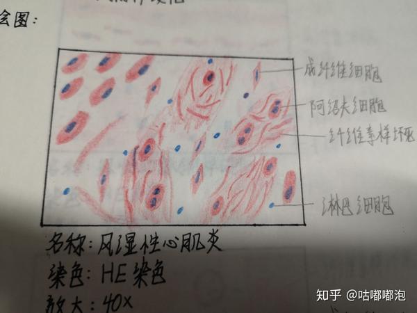 18.动脉粥样硬化