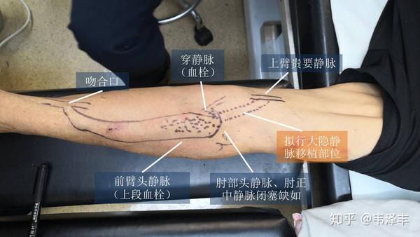 患者肘部静脉cto,通过侧枝回流,需建立回心的通路:1,人造血管搭桥?