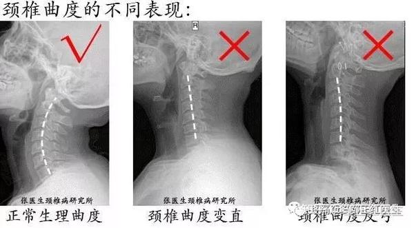 上图是颈椎正常曲度图,正常的颈椎曲线是具有一个前凸的曲度,以