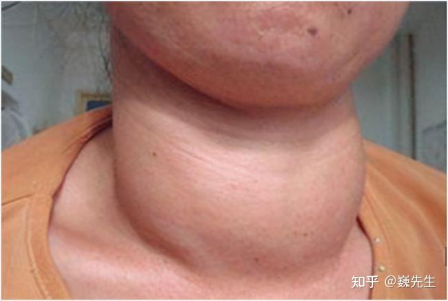 甲状腺结节来临前,脖子会出现3个明显"破绽",劝你早点