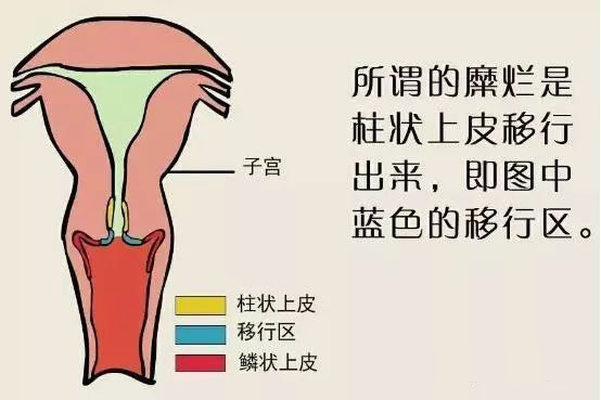 而宫颈管内通常都是柱状上皮细胞覆盖,它就显得凹凸不平.