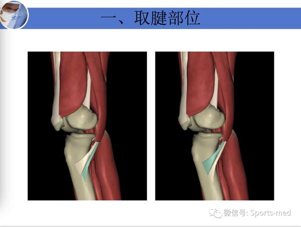 前交叉韧带重建术中肌腱移植物的准备