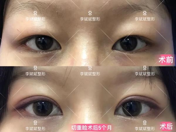 上睑下垂