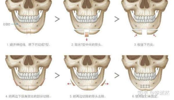 而颏成型手术又可以分为 单纯截骨前移和 下巴t字截骨前移两种手术
