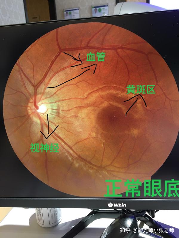 高度近视不可怕可怕的是眼底病变