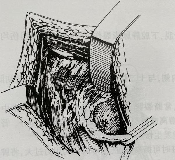 肾切除术是怎么做的