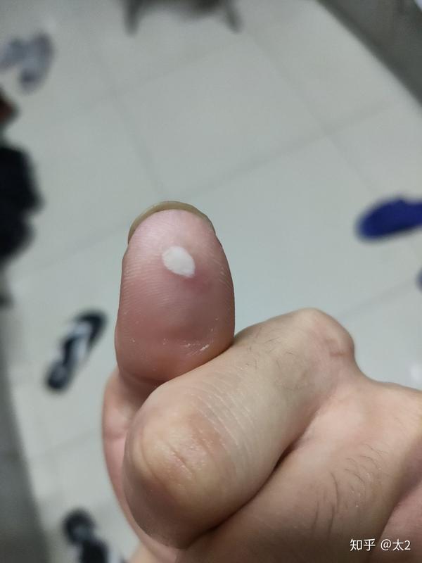 大拇指上长了一块白的,还越来越大,是怎么回事