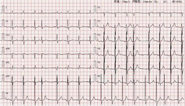 心电图图库丨左室大左室高电压