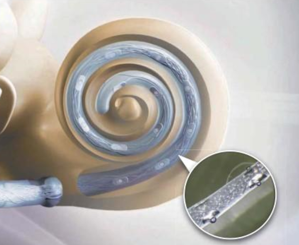 人工耳蜗植入体