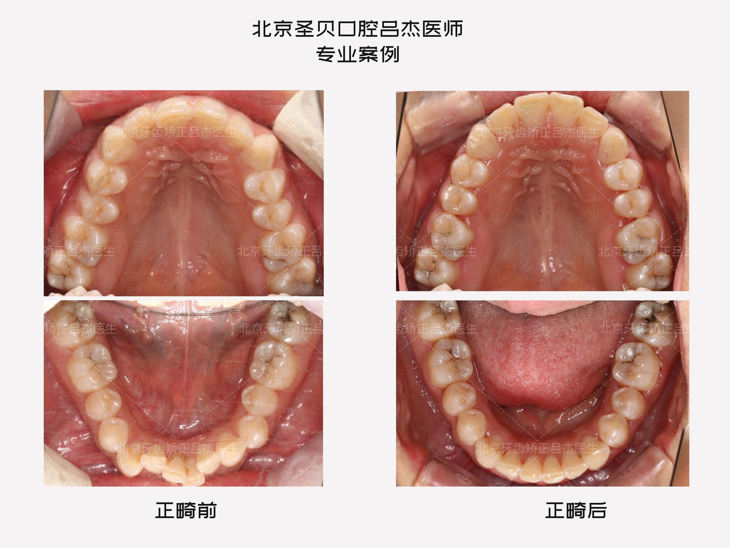 【案例分享】牙列拥挤1年结束矫正