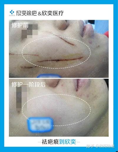 上述患者的疤痕现在的情况完全可以通过最简单的药物修复,最终恢复
