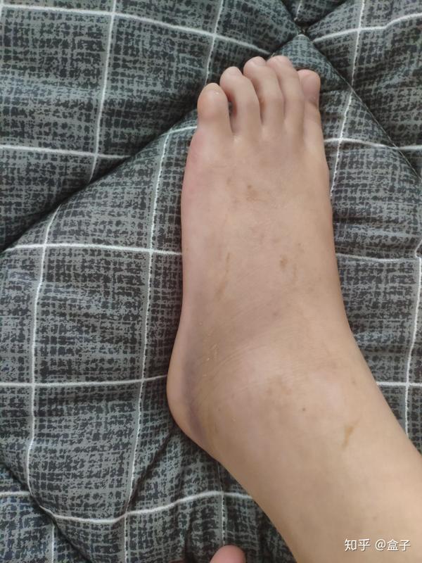 脚扭了半个月还没好,有同病相怜的?