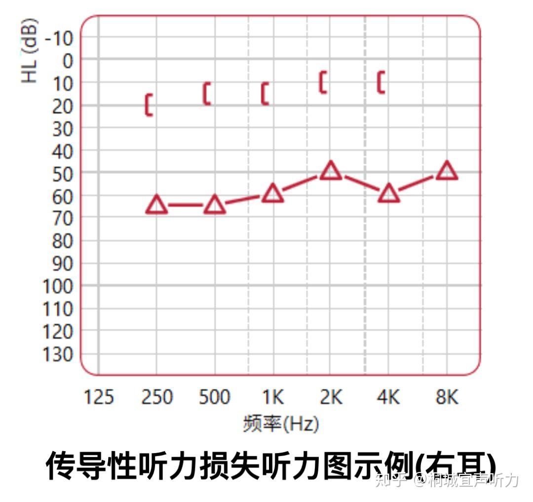 宜声听力跟你说说为什么两条曲线决定耳朵的命运