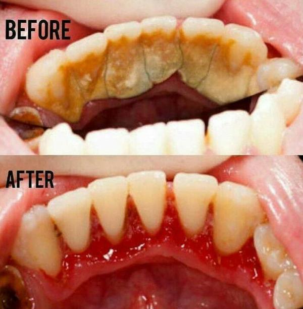 洗牙之前和之后,牙龈损失得很严重,需要过三个月回来再次洗牙,可能