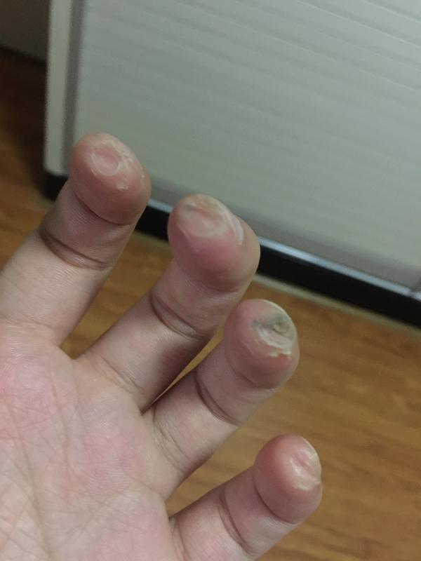 为什么弹吉他好久了手都长茧了,弹还是会疼?