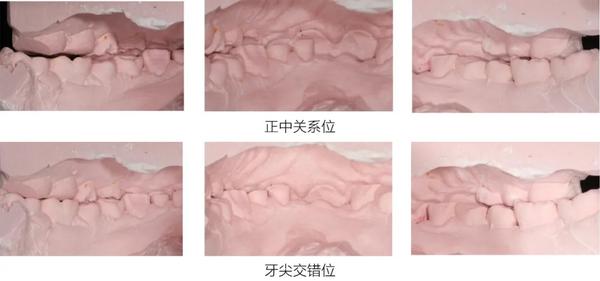 正中关系位到牙尖交错位存在偏移; 2.过陡的前导角度; 3.