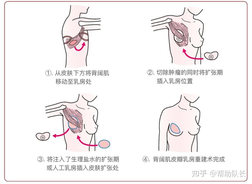 乳腺癌切除手术时在皮下放入扩张器,向扩张期内注入生理盐水使乳房