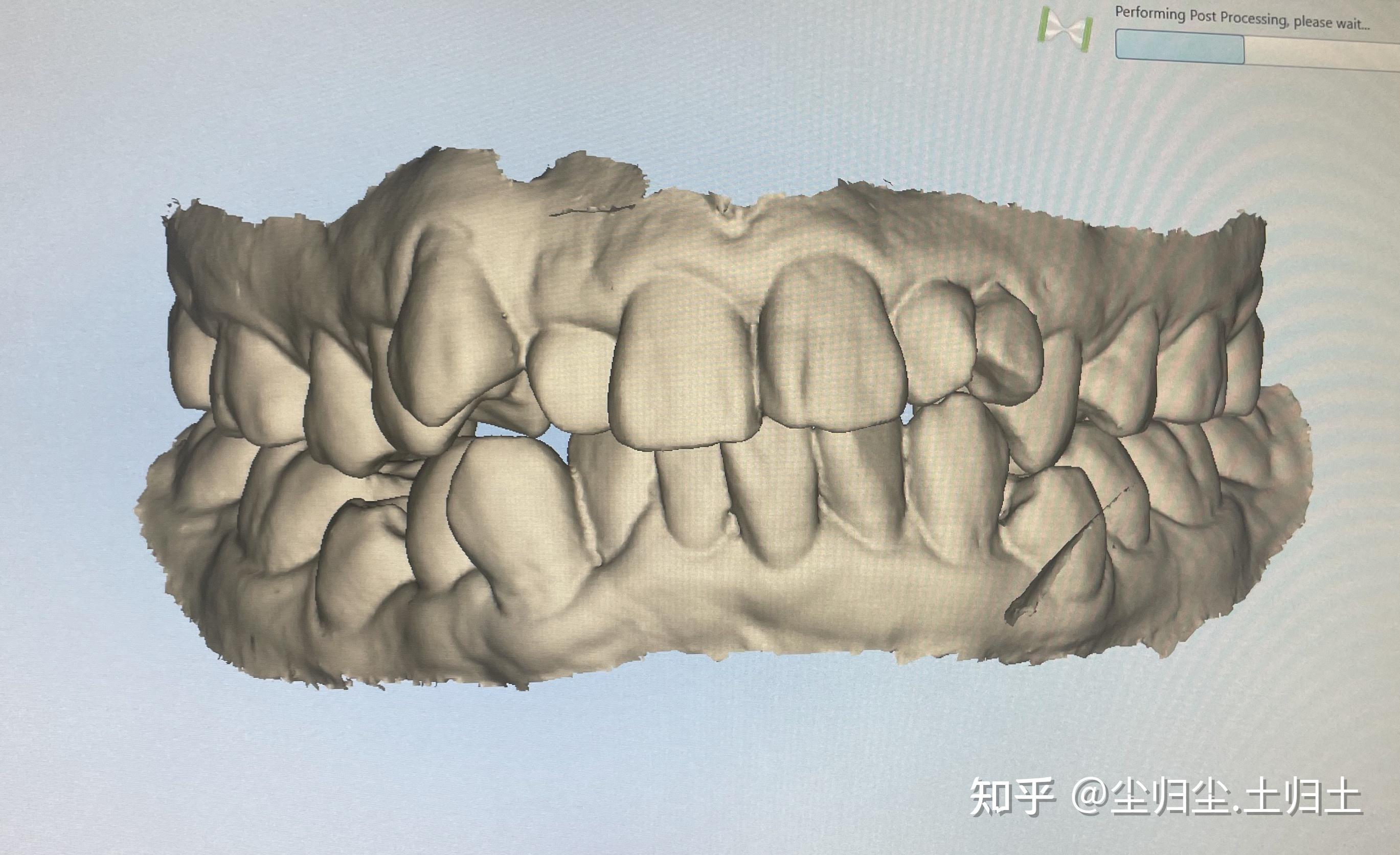 骨科透视图31颗牙,3颗智齿,前面有说过我的牙齿情况比较复杂,就是