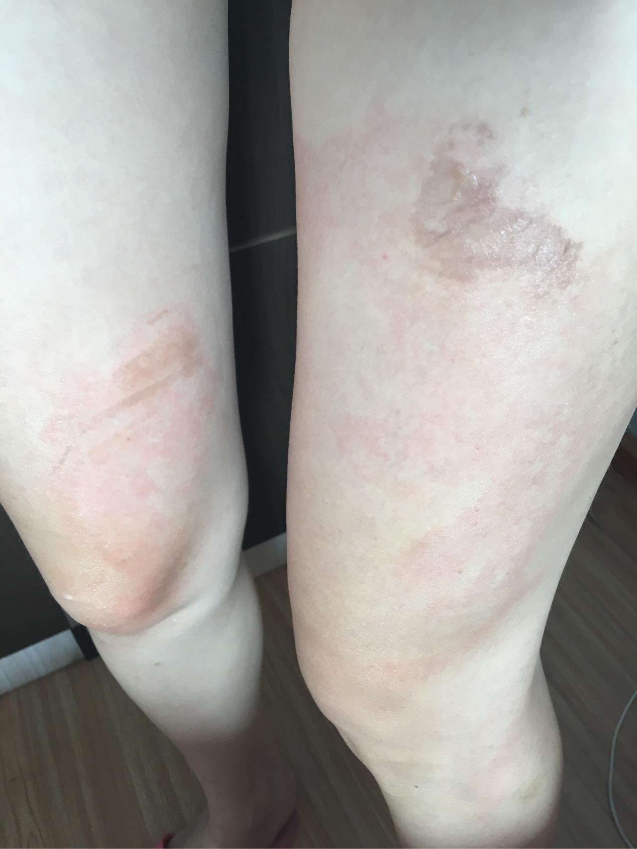 不小心将稀饭洒腿上了烫了泡怎么处理