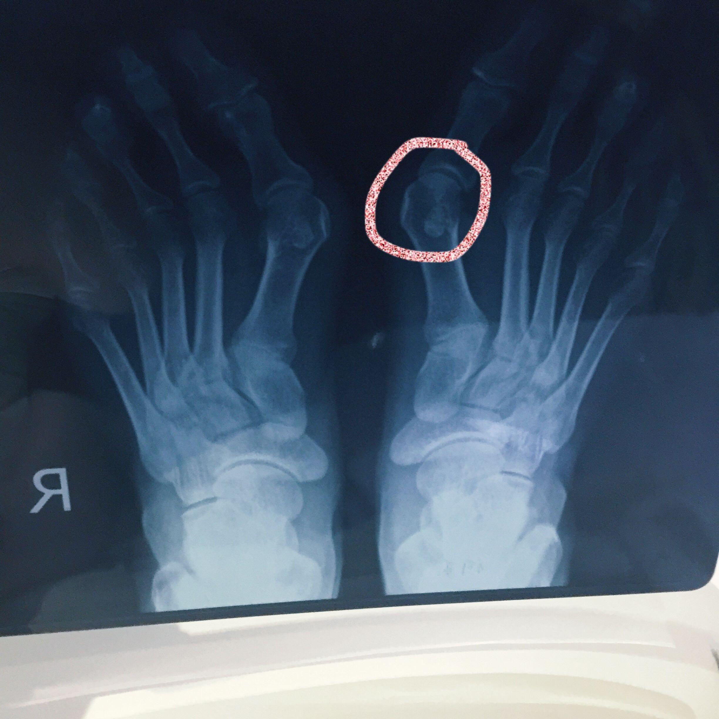 右手第五掌骨骨折，手术复位并植入钢钉固定，一月拆石膏，40天拔钢钉，现在44天，小拇指无法顺利弯曲。_百度知道
