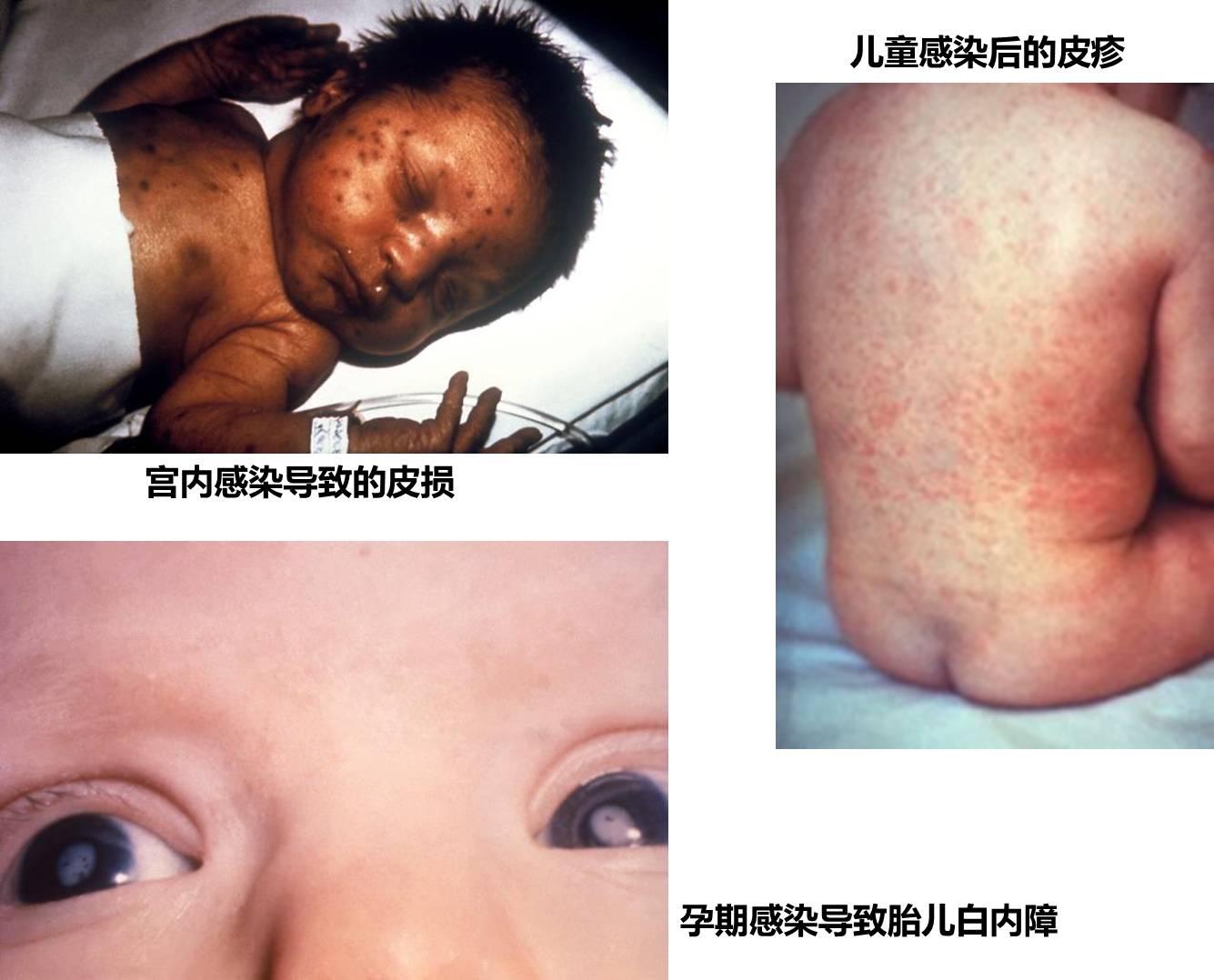 分析慢性荨麻疹有哪些危害-长春华山皮肤病医院