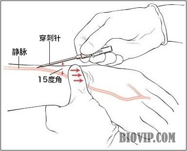 中心静脉穿刺点图片