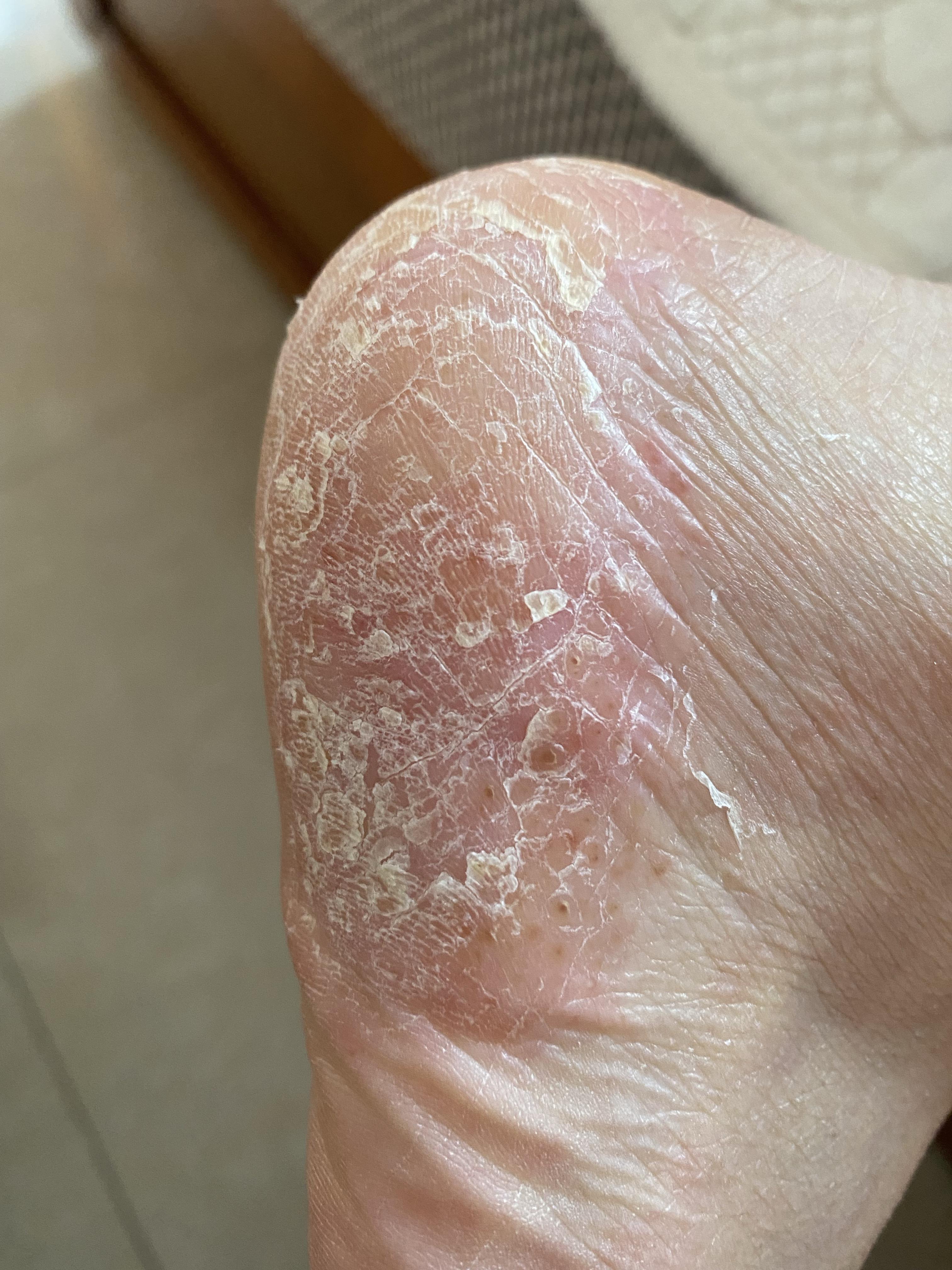 爱吃芒果的傻菇凉 的想法: 脚上总是起皮 小疱疹 有时会痛 请问有没有