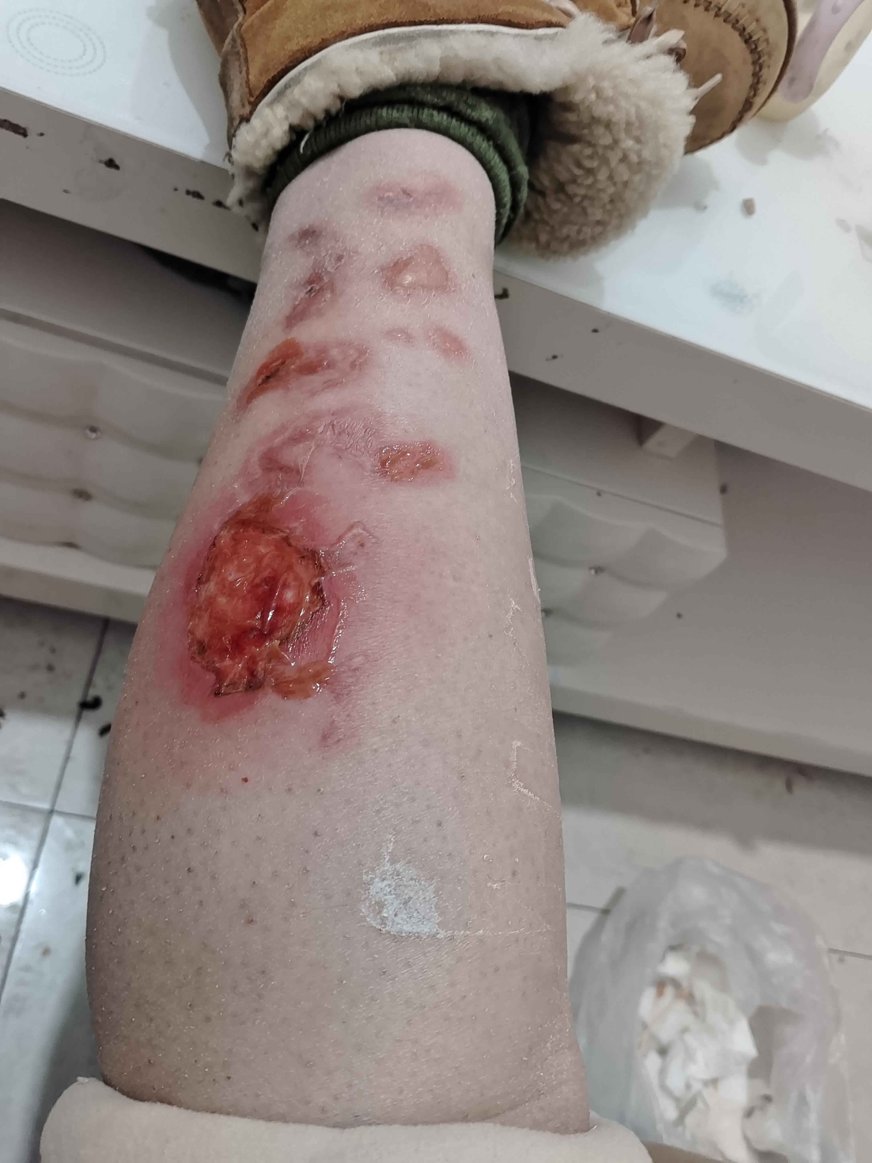 举世无双 的想法: 腿被热水袋烫伤的痊愈过程