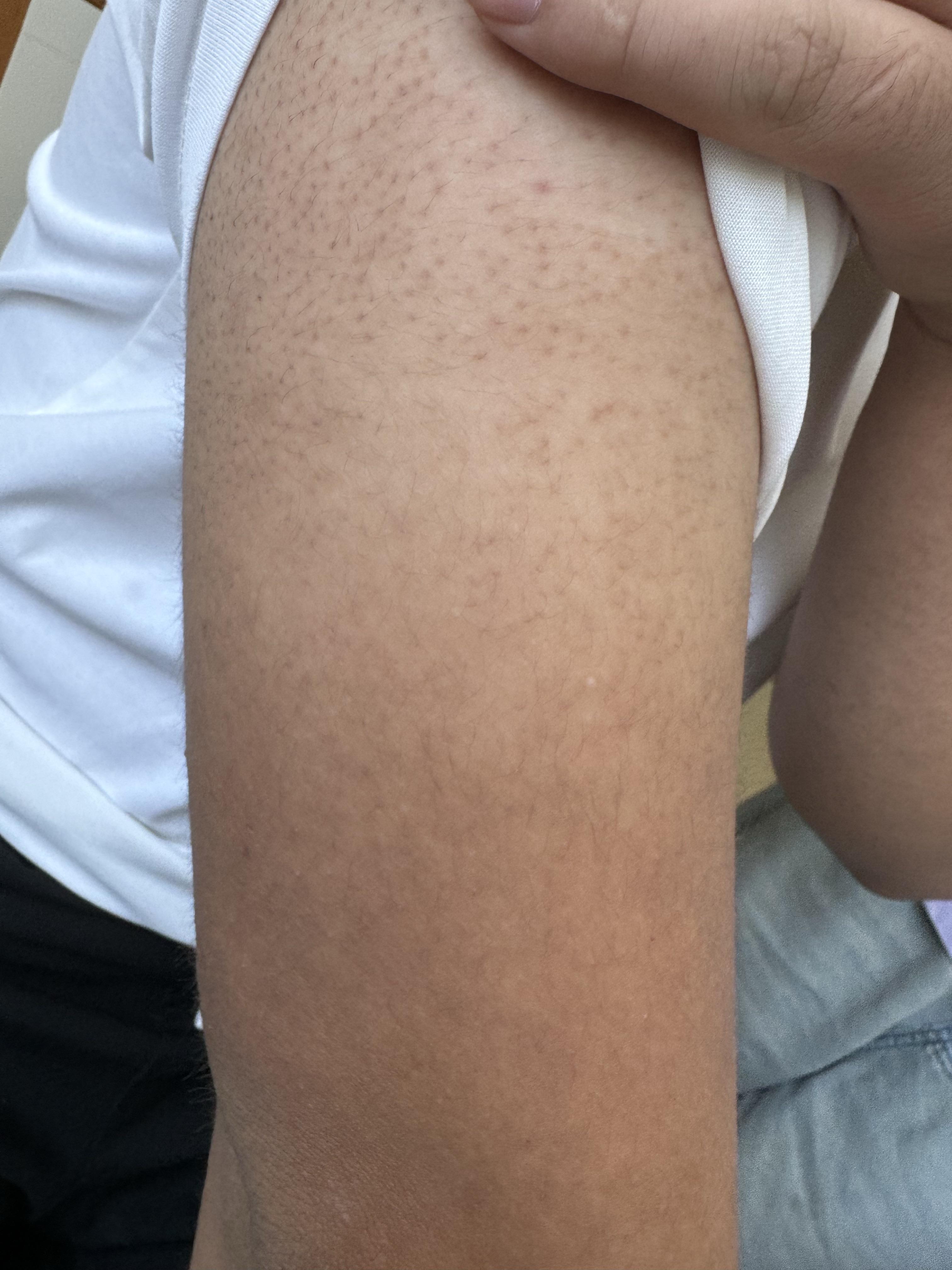 毛周角化症就是俗称的"鸡皮肤",的确和遗传有关,只是每个人表现的