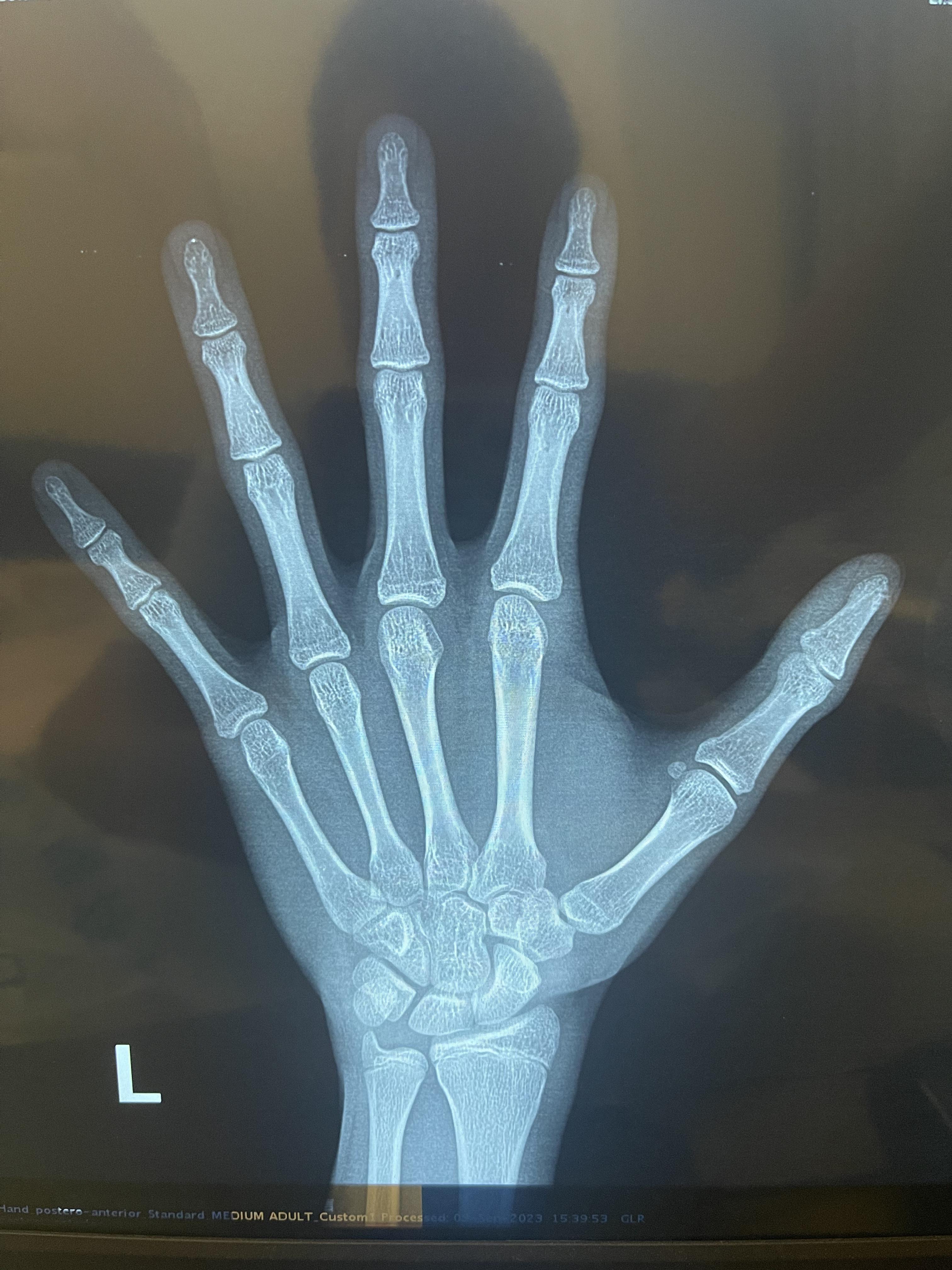 骨龄鉴定徐永剑 的想法: 见到这类骨龄片,孩子基本已经非常难长了