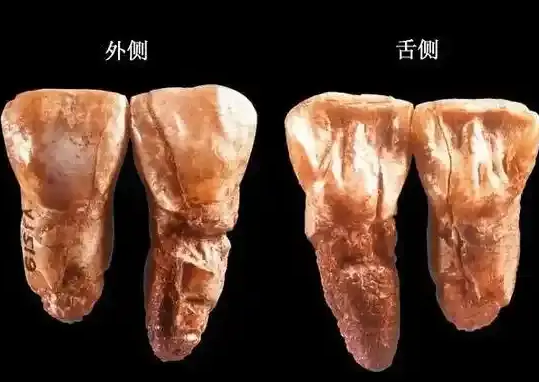 美呀植牙牙医说 的想法: 你的门牙藏着“东亚身份证”！铲形门齿的秘密与护牙指南 | 小伙伴们，照镜子时有没有发现自己的上门牙内… - 知乎