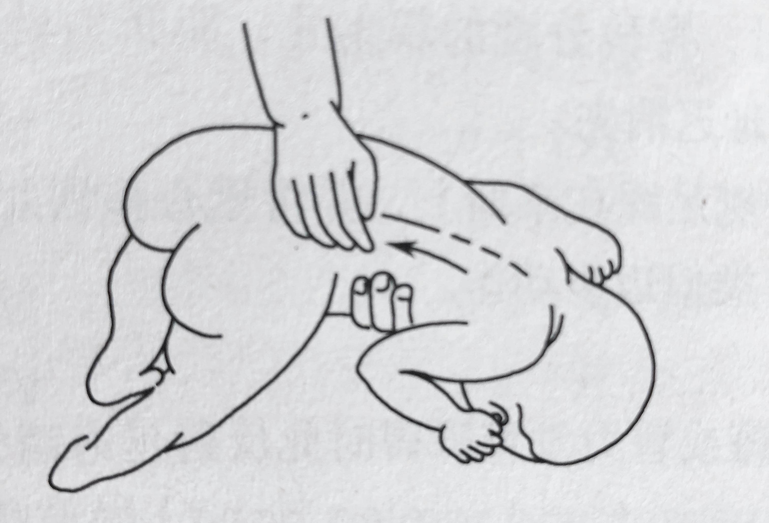 侧弯反射 br>又称躯干内弯反射 br>肌张力低下难以引出,肌张力增高