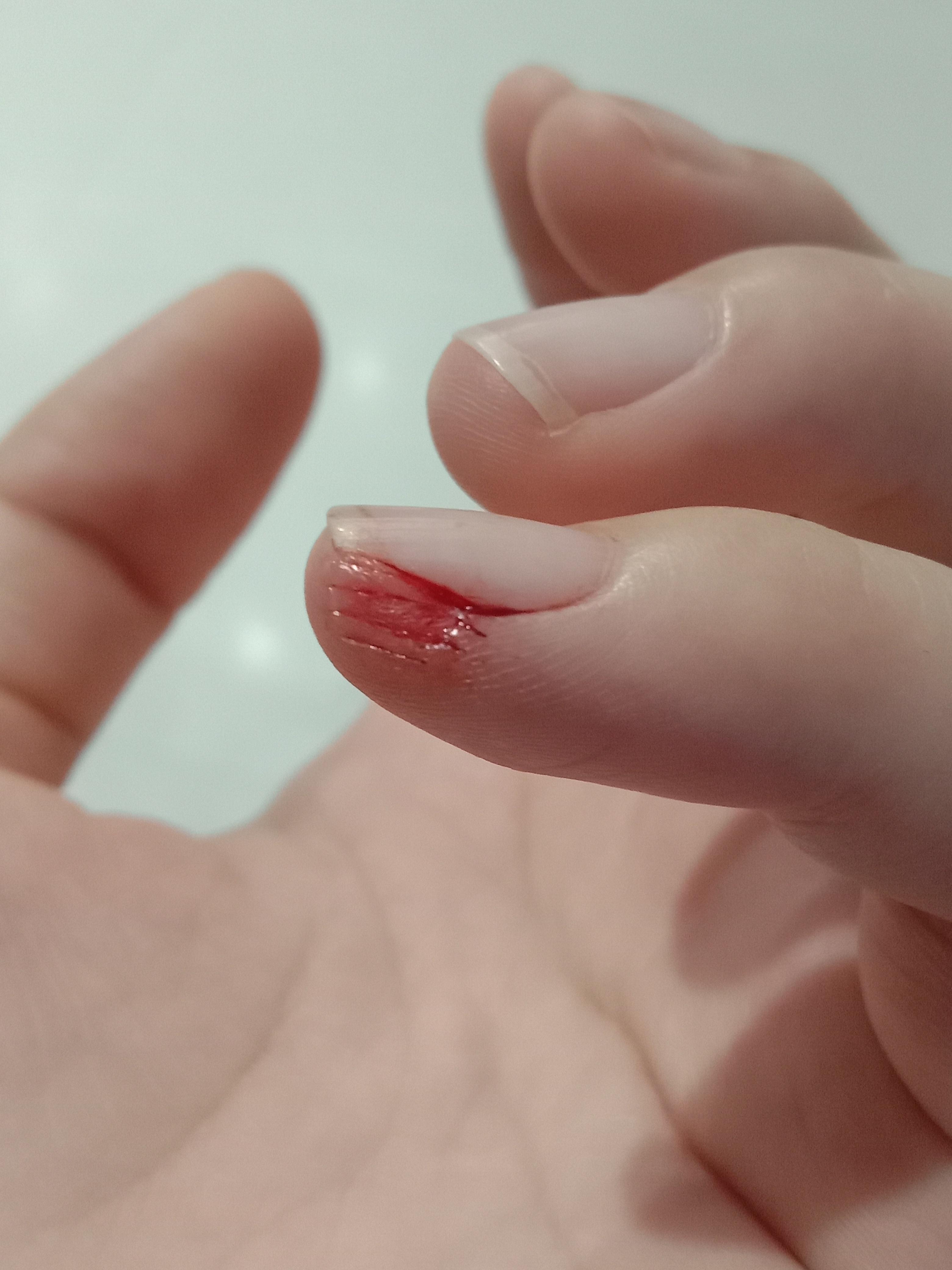 花生 的想法: 手受伤了你们会怎么处理