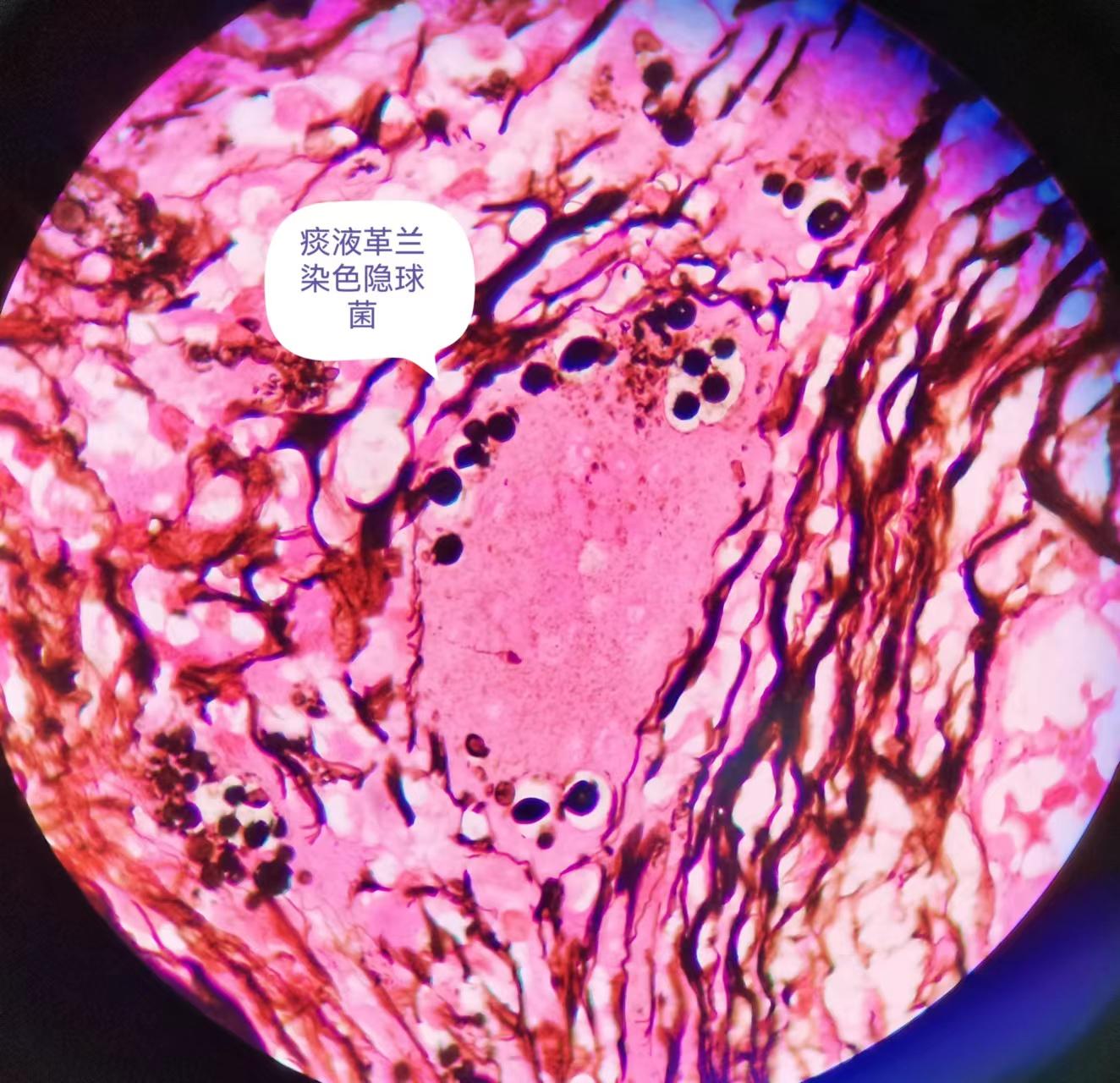 新型隐球菌形态特点图片