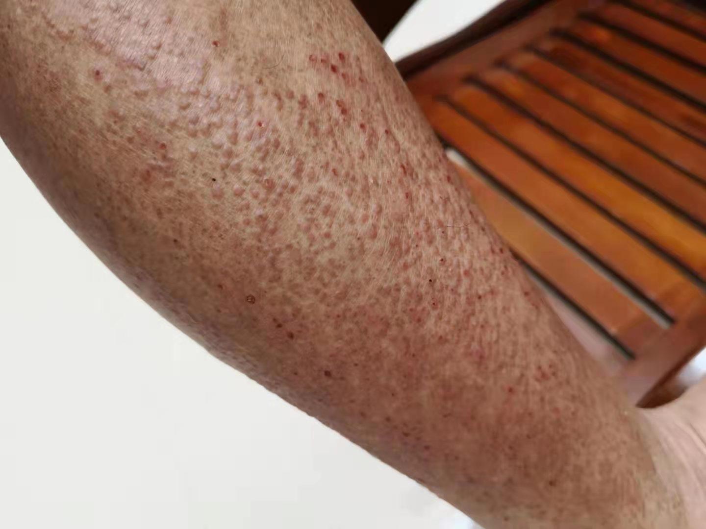  br>皮肤淀粉样变是一种淀粉样物质在组织中沉积所引起的皮肤病变,属