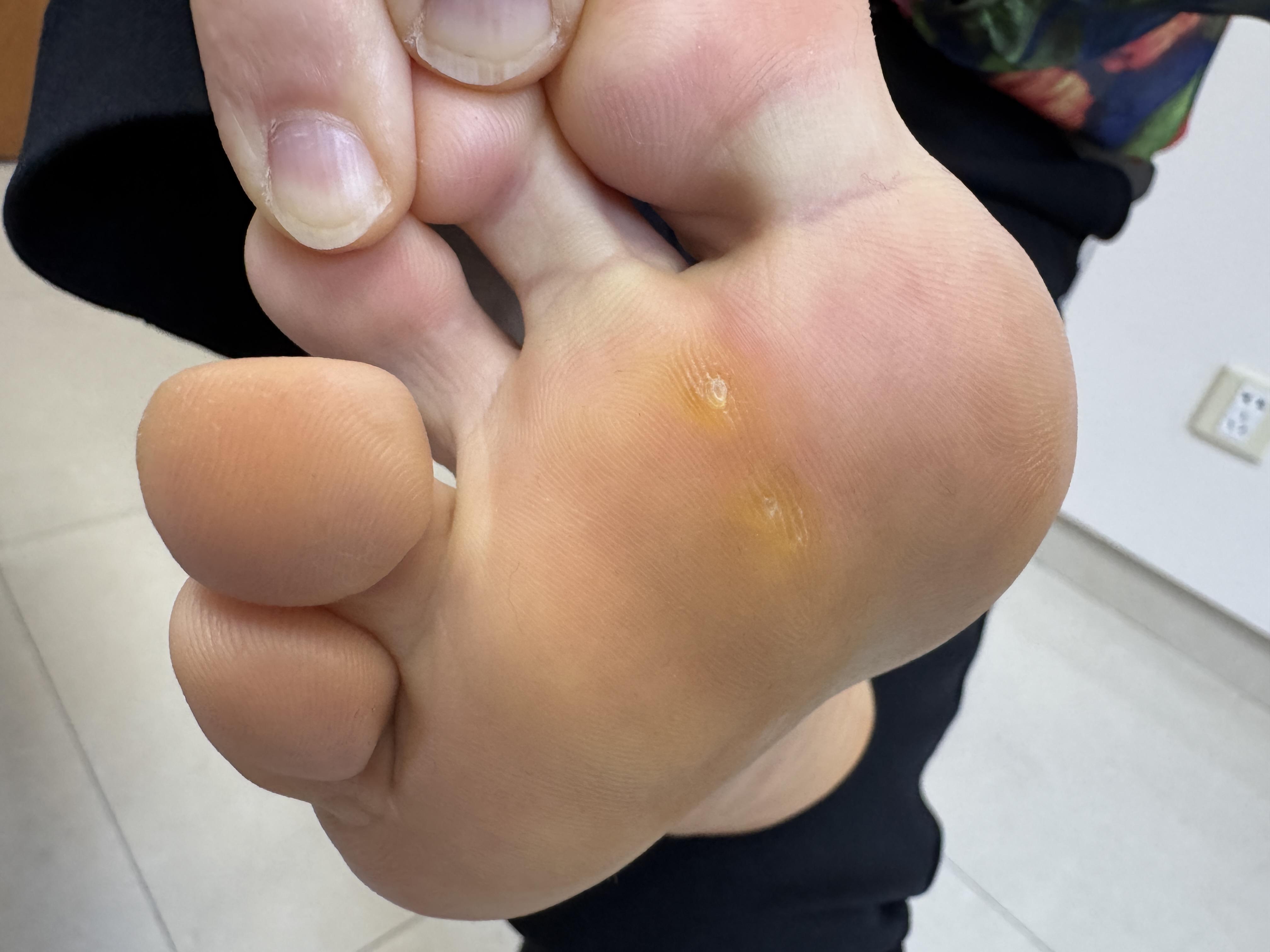 护肤在西塘 的想法: 鸡眼和老茧,什么关系?