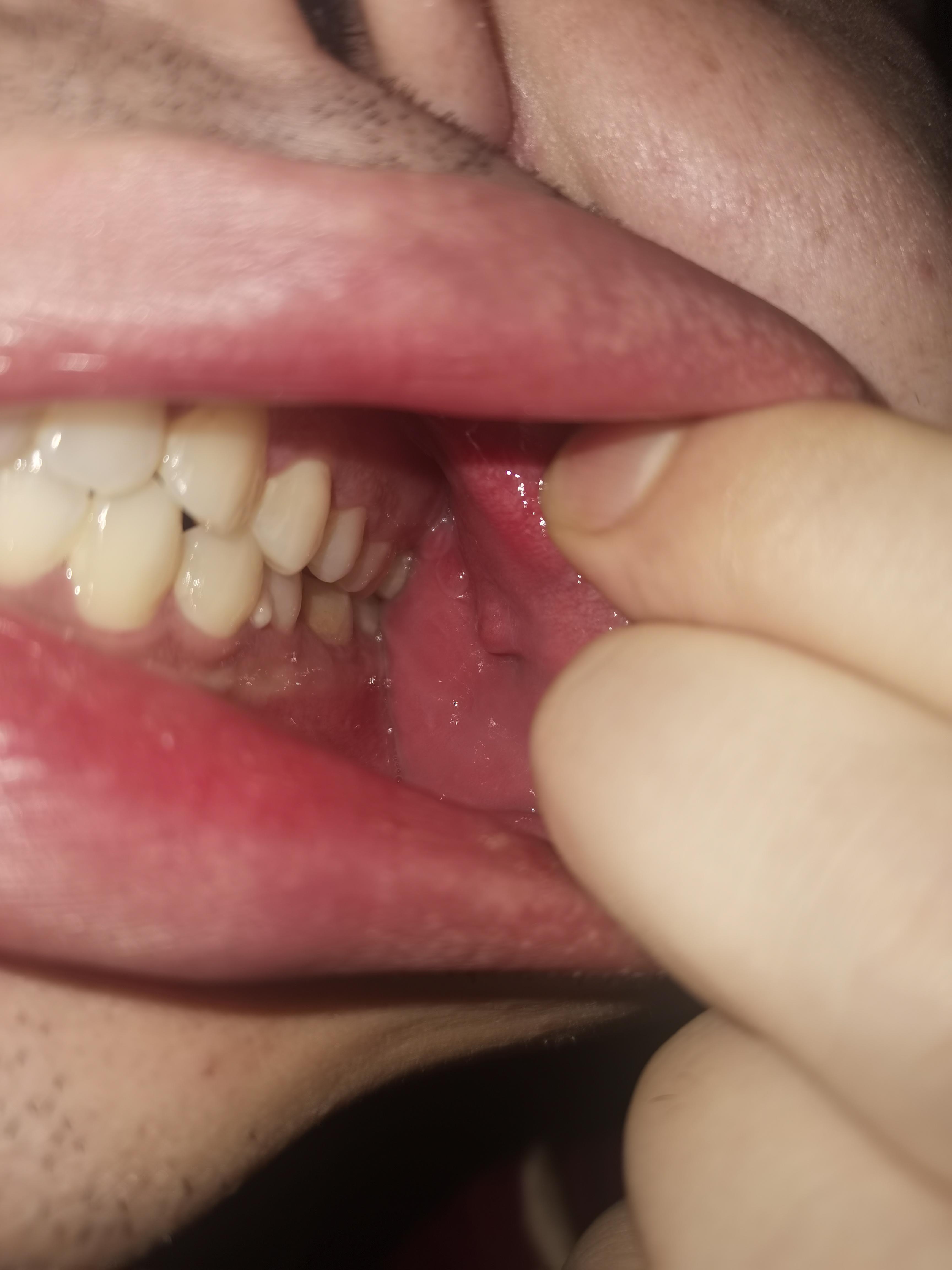 爱的色纺 的想法: 口腔粘膜长了三个这个是什么啊才发现的需要手术吗