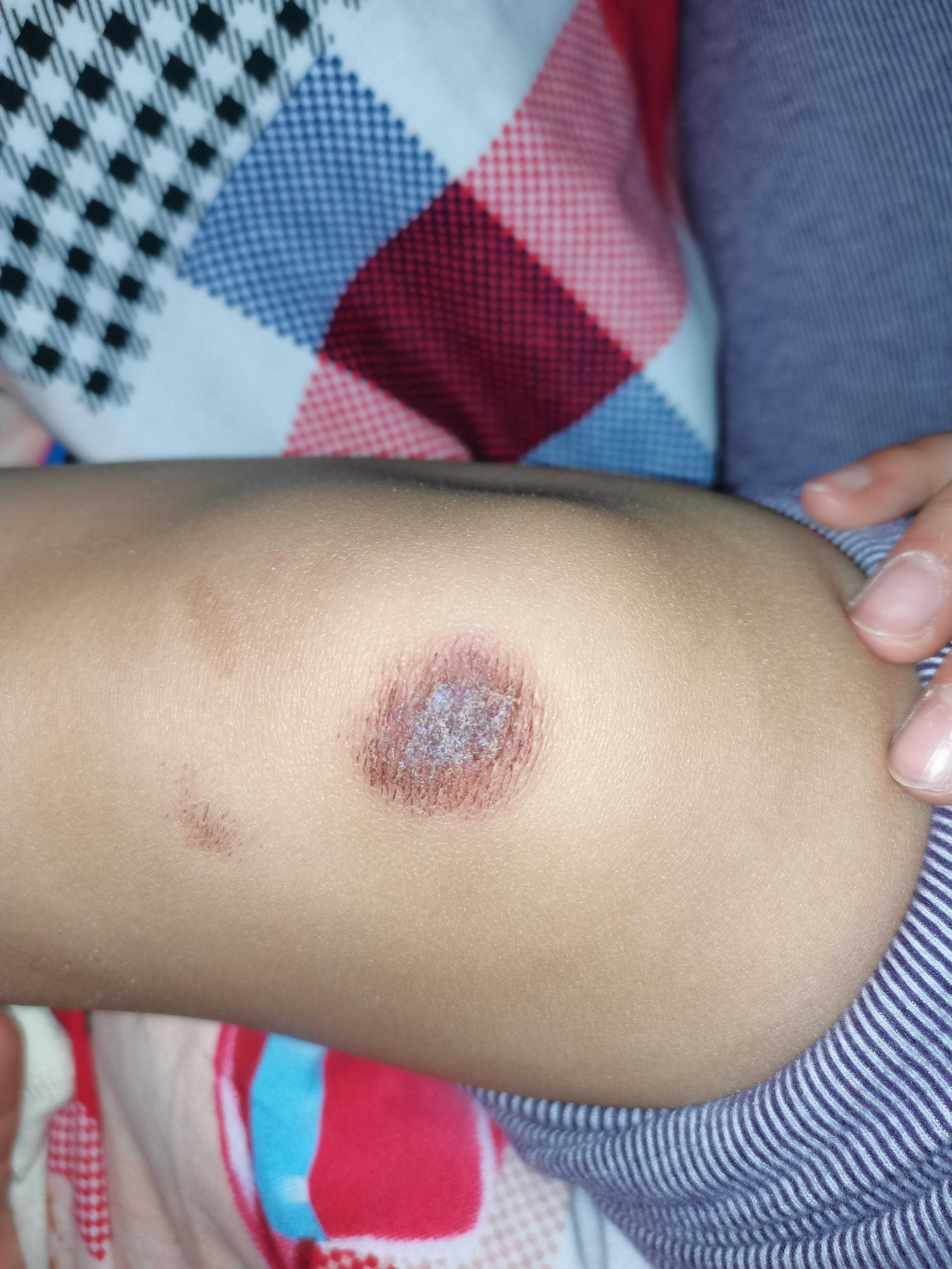 sz0vnb 的想法: 这个伤疤是要多久才能痊愈😭