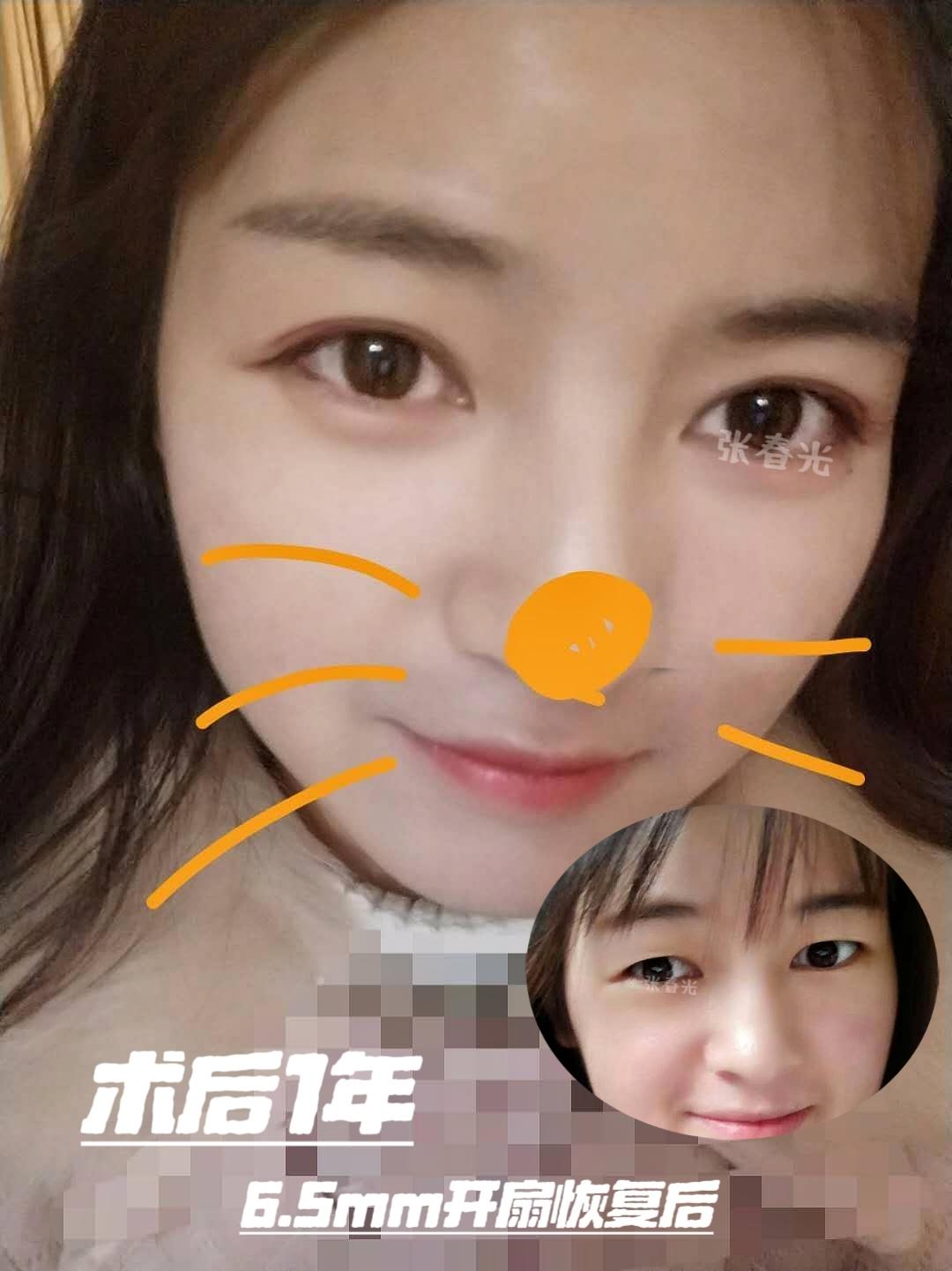 5mm开扇双眼皮1年后是什么样子?