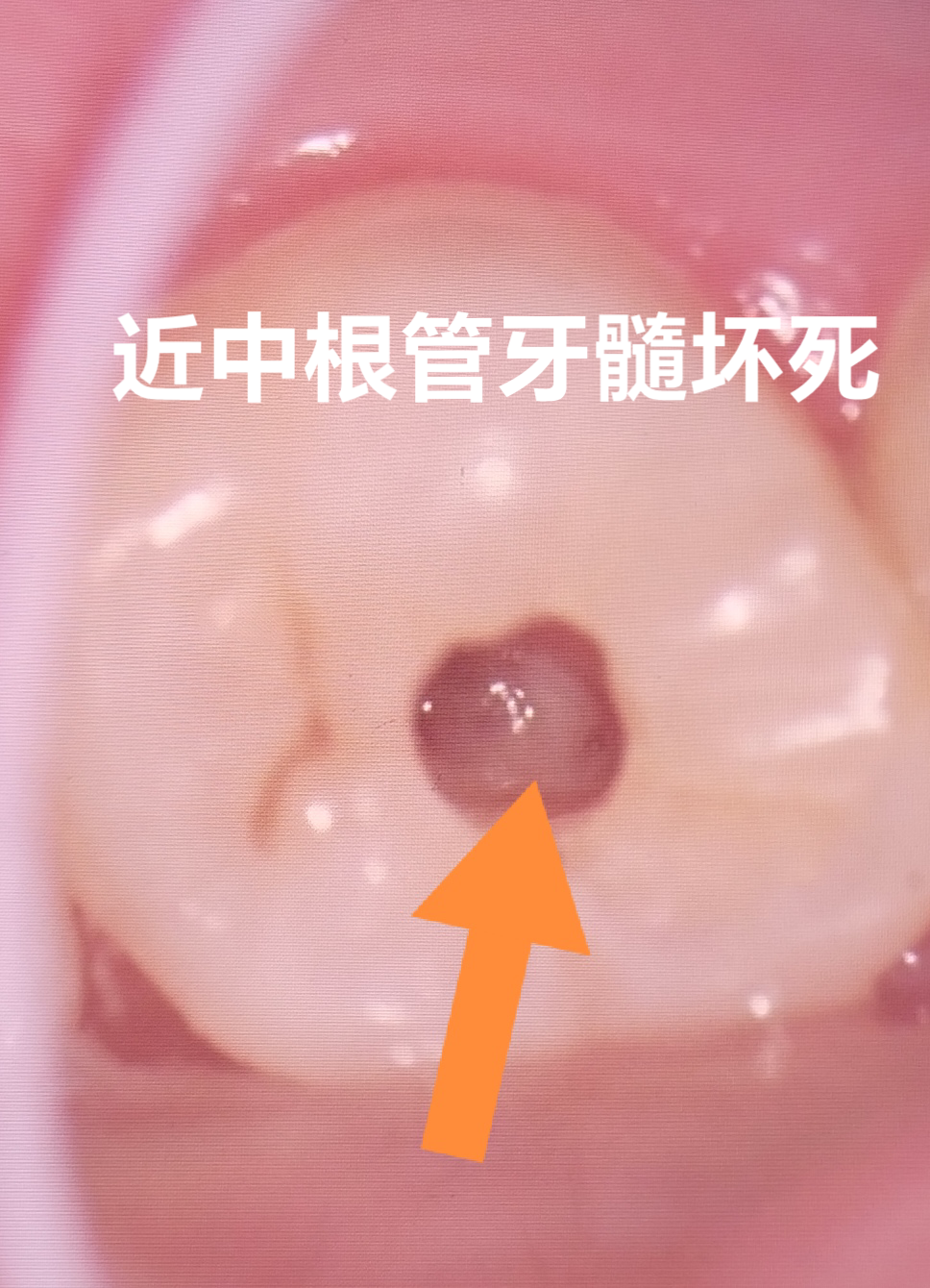 深圳周奇峰 的想法 活髓保存可以保多长时间?